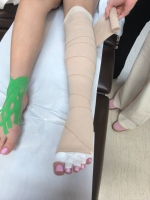 Kompresoterapia
 Taping 
limfatyczny